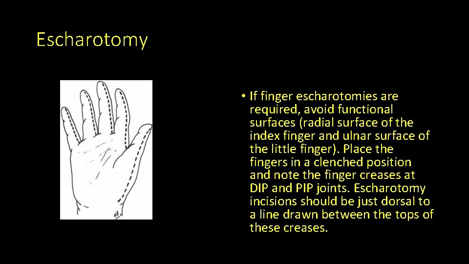 Escharotomy • If finger escharotomies are required, avoid functional surfaces (radial surface of the
