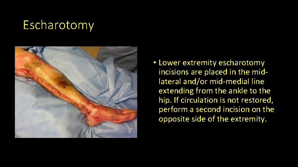 Escharotomy • Lower extremity escharotomy incisions are placed in the midlateral and/or mid-medial line