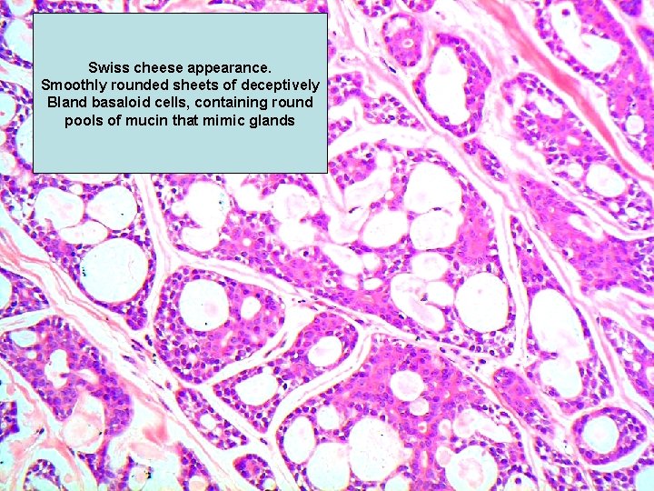 Swiss cheese appearance. Smoothly rounded sheets of deceptively Bland basaloid cells, containing round pools