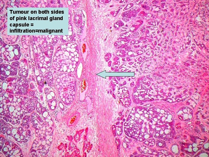 Tumour on both sides of pink lacrimal gland capsule = infiltration=malignant 