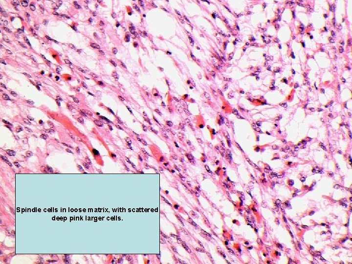 Spindle cells in loose matrix, with scattered deep pink larger cells. 