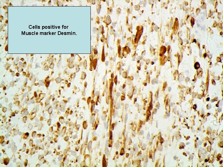 Cells positive for Muscle marker Desmin. 