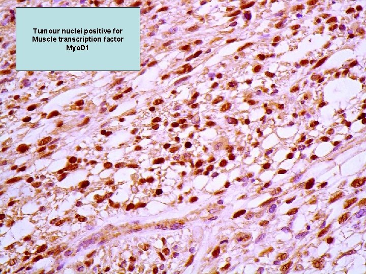 Tumour nuclei positive for Muscle transcription factor Myo. D 1 