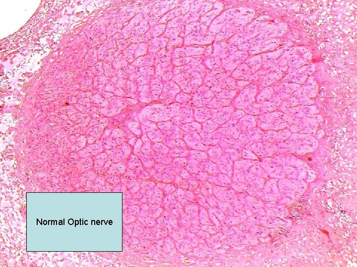 Normal Optic nerve 