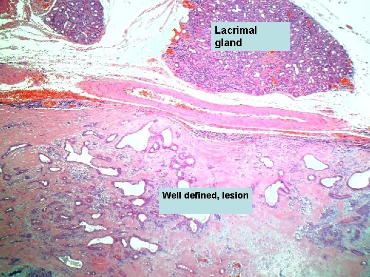 Lacrimal gland Well defined, lesion 