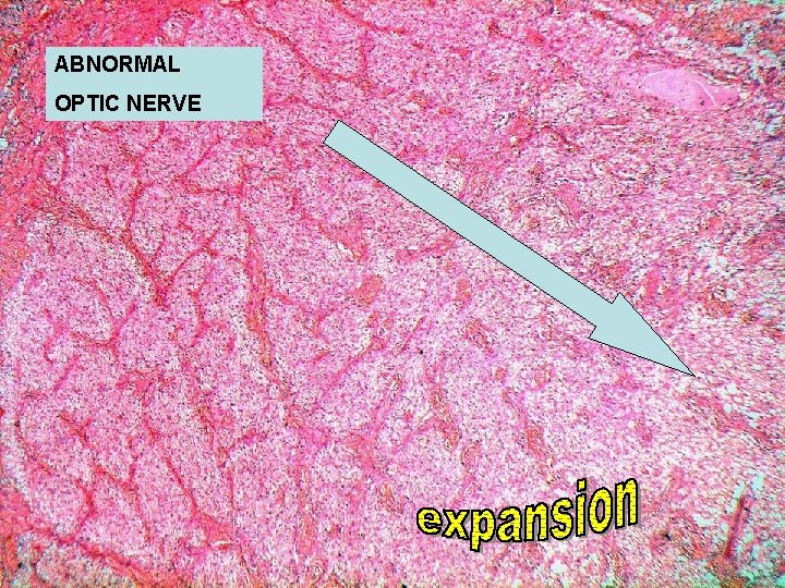 ABNORMAL OPTIC NERVE 