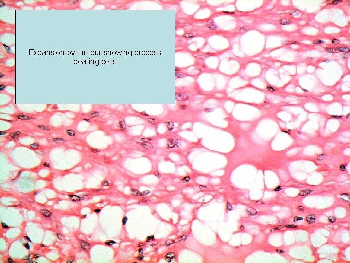 Expansion by tumour showing process bearing cells 