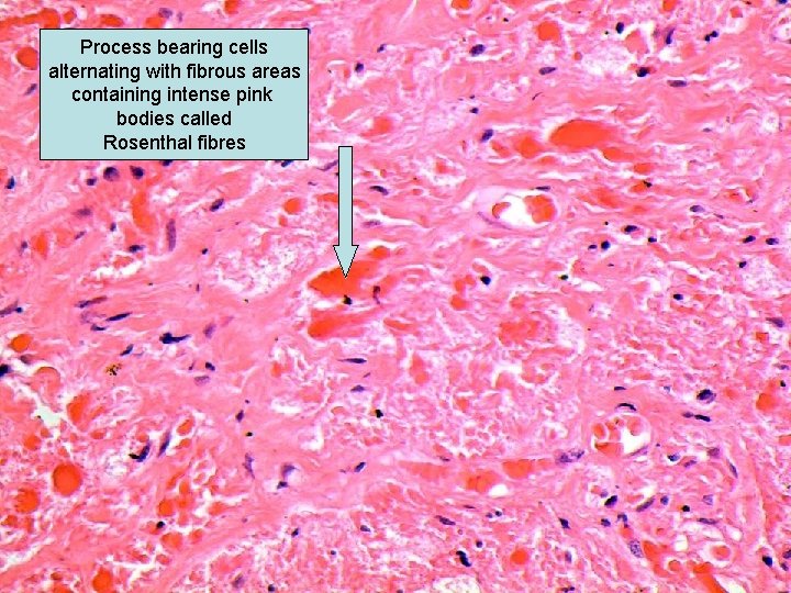 Process bearing cells alternating with fibrous areas containing intense pink bodies called Rosenthal fibres