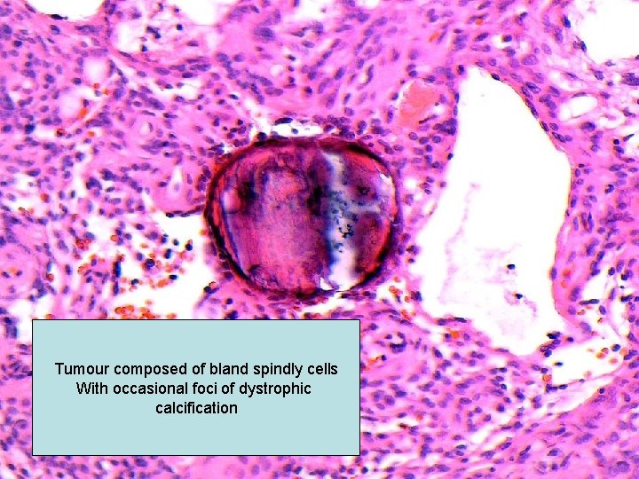 Tumour composed of bland spindly cells With occasional foci of dystrophic calcification 