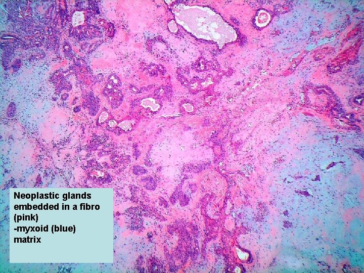 Neoplastic glands embedded in a fibro (pink) -myxoid (blue) matrix 