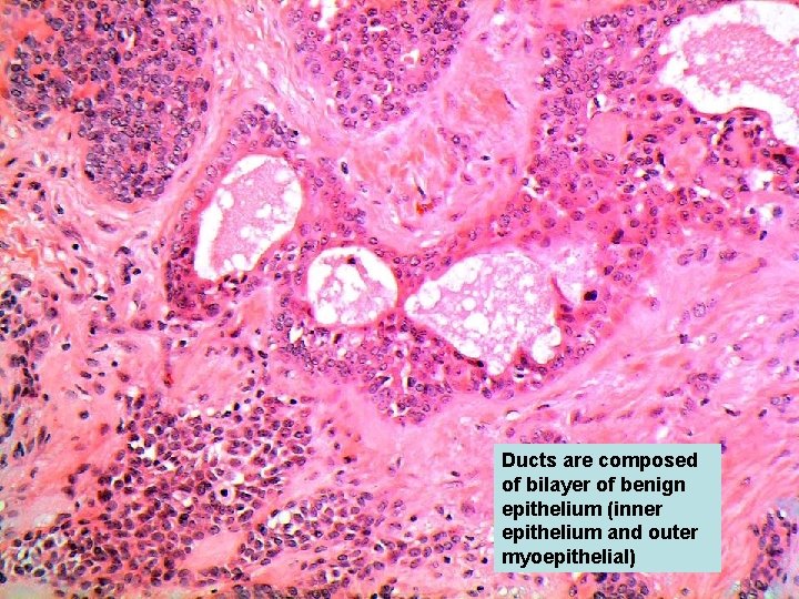 Ducts are composed of bilayer of benign epithelium (inner epithelium and outer myoepithelial) 