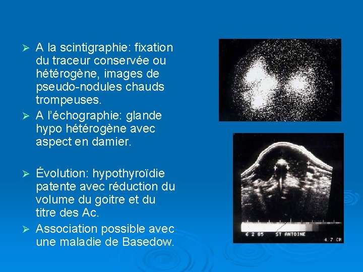 A la scintigraphie: fixation du traceur conservée ou hétérogène, images de pseudo-nodules chauds trompeuses.