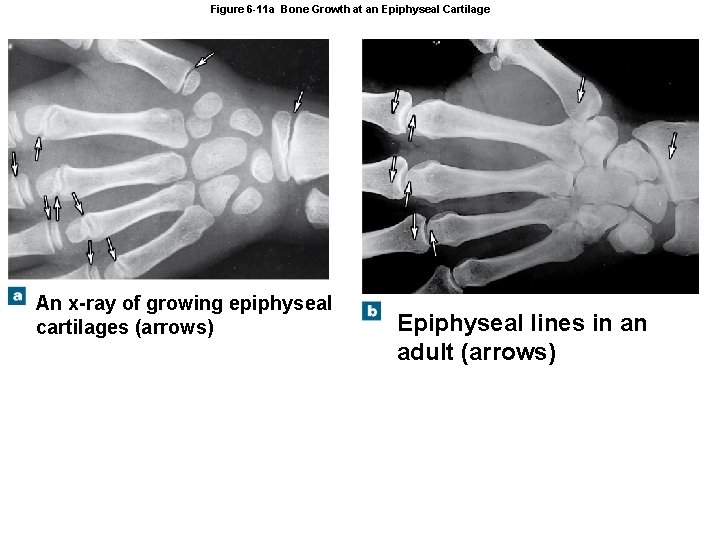 Figure 6 -11 a Bone Growth at an Epiphyseal Cartilage An x-ray of growing