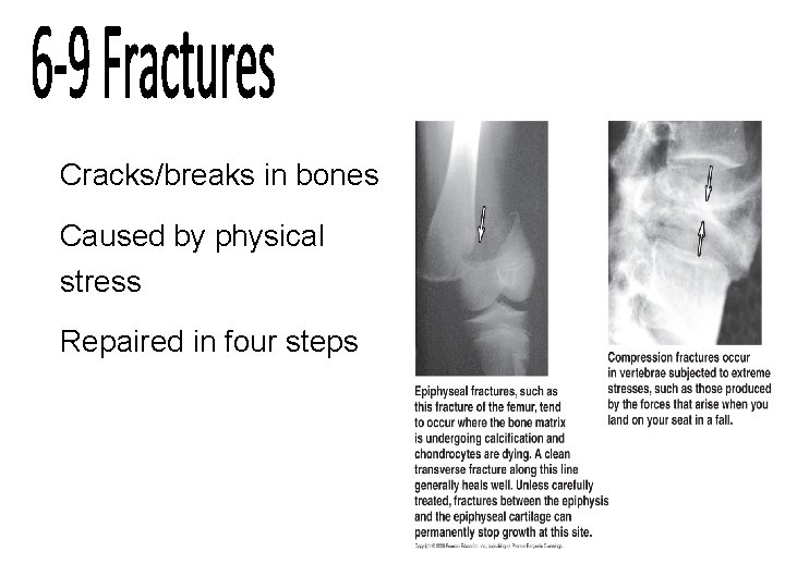 Cracks/breaks in bones Caused by physical stress Repaired in four steps 