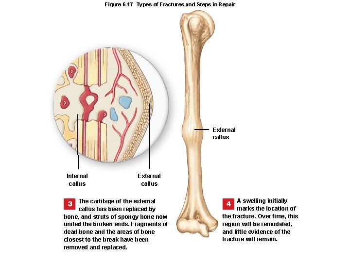 Figure 6 -17 Types of Fractures and Steps in Repair External callus Internal callus