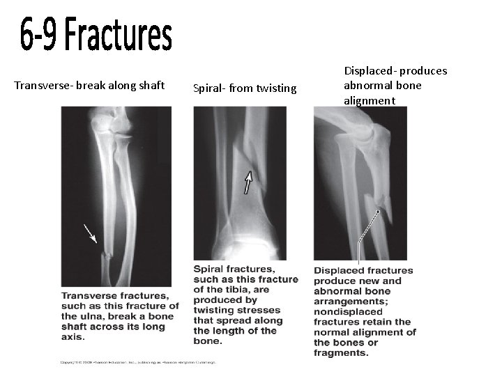 Transverse- break along shaft Spiral- from twisting Displaced- produces abnormal bone alignment 