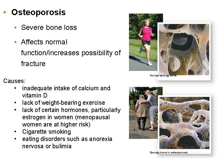  • Osteoporosis • Severe bone loss • Affects normal function/increases possibility of fracture