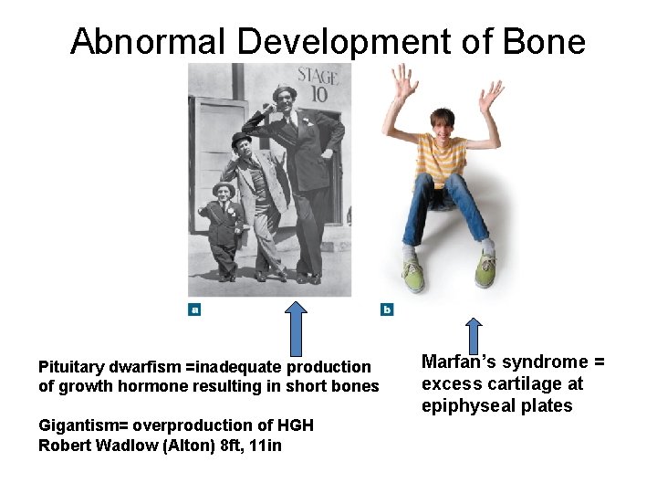 Abnormal Development of Bone Pituitary dwarfism =inadequate production of growth hormone resulting in short