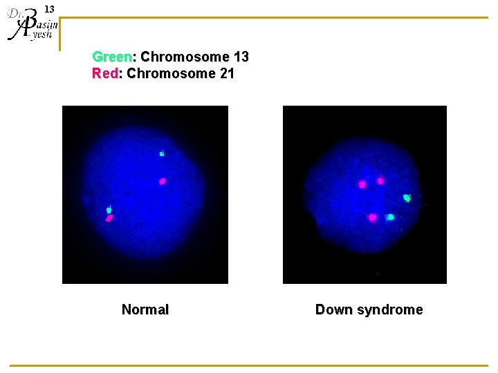 13 Green: Chromosome 13 Red: Chromosome 21 Normal Down syndrome 