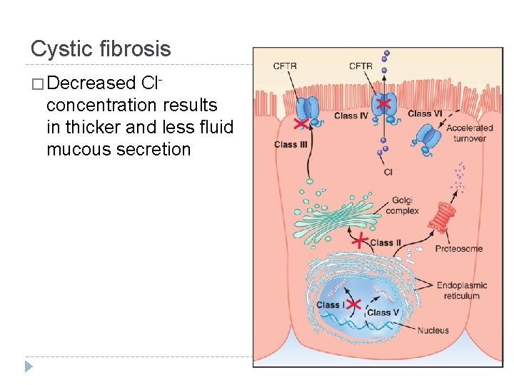 Cystic fibrosis � Decreased Clconcentration results in thicker and less fluid mucous secretion 