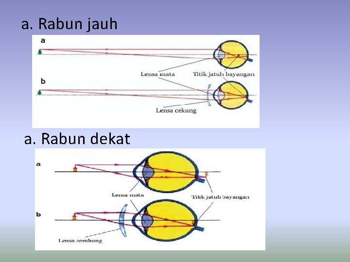 a. Rabun jauh a. Rabun dekat 