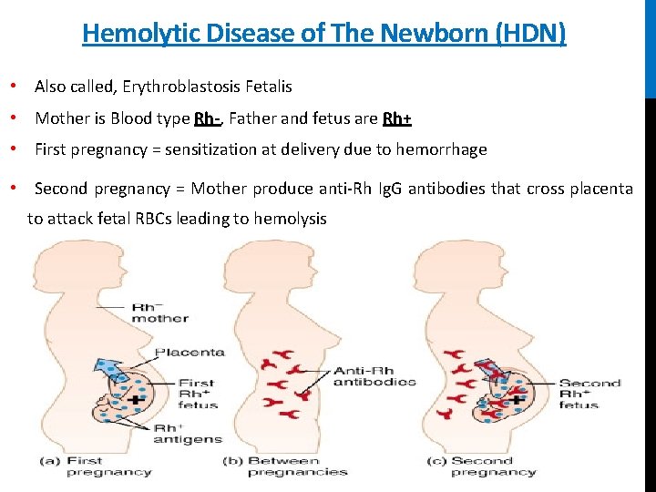 Hemolytic Disease of The Newborn (HDN) • Also called, Erythroblastosis Fetalis • Mother is