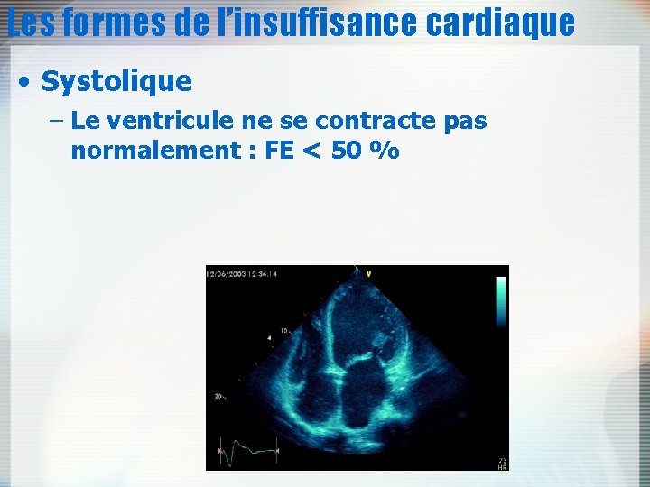 Les formes de l’insuffisance cardiaque • Systolique – Le ventricule ne se contracte pas