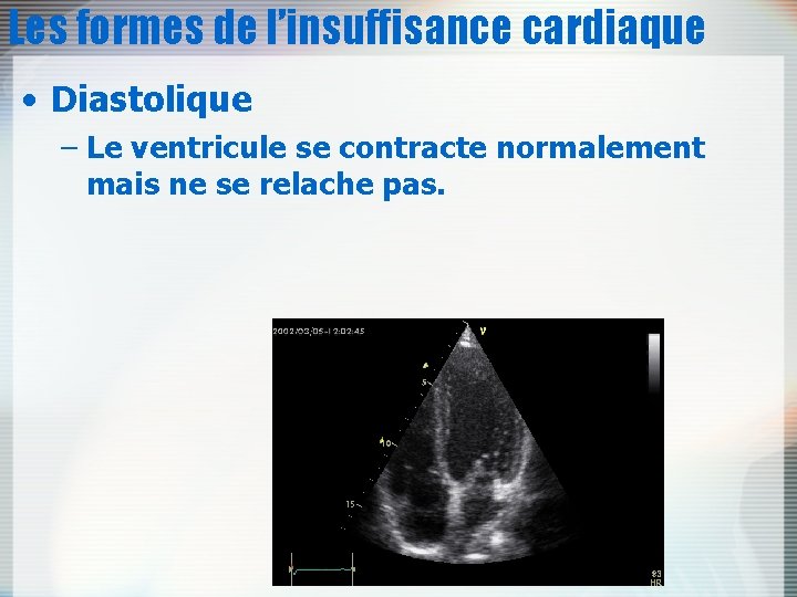 Les formes de l’insuffisance cardiaque • Diastolique – Le ventricule se contracte normalement mais