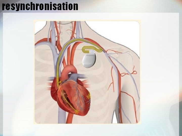 resynchronisation 