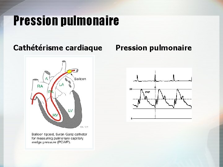 Pression pulmonaire Cathétérisme cardiaque Pression pulmonaire 