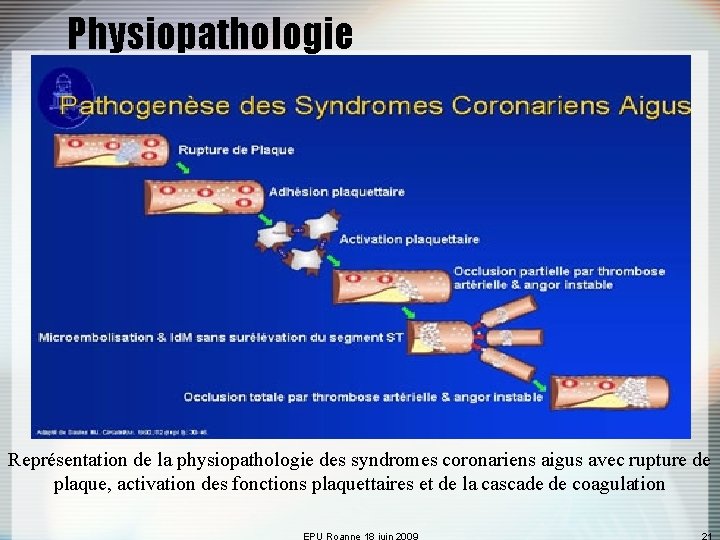 Physiopathologie Représentation de la physiopathologie des syndromes coronariens aigus avec rupture de plaque, activation