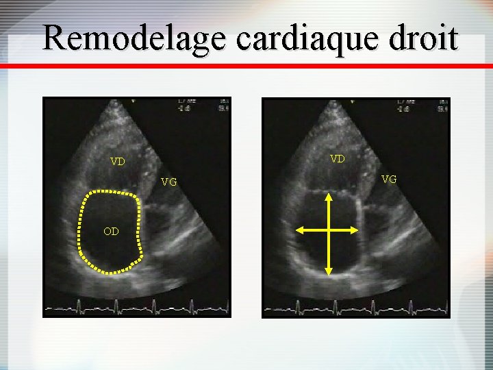 Remodelage cardiaque droit VD VD VG OD VG 