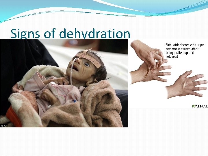 Signs of dehydration 