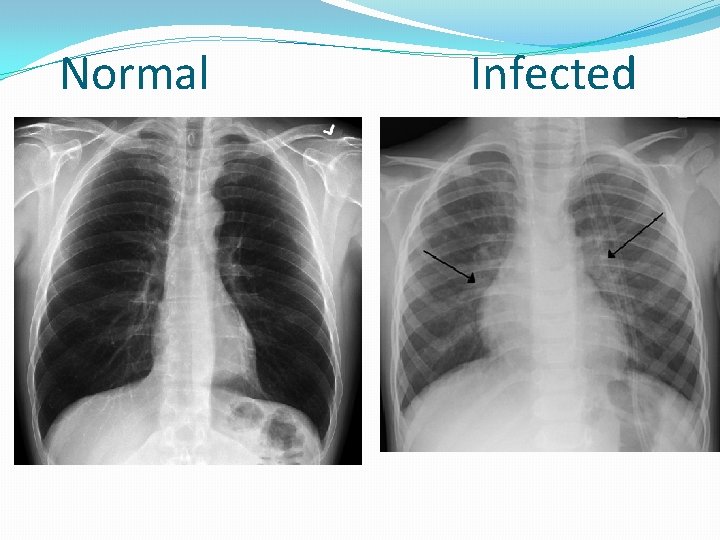 Normal Infected 