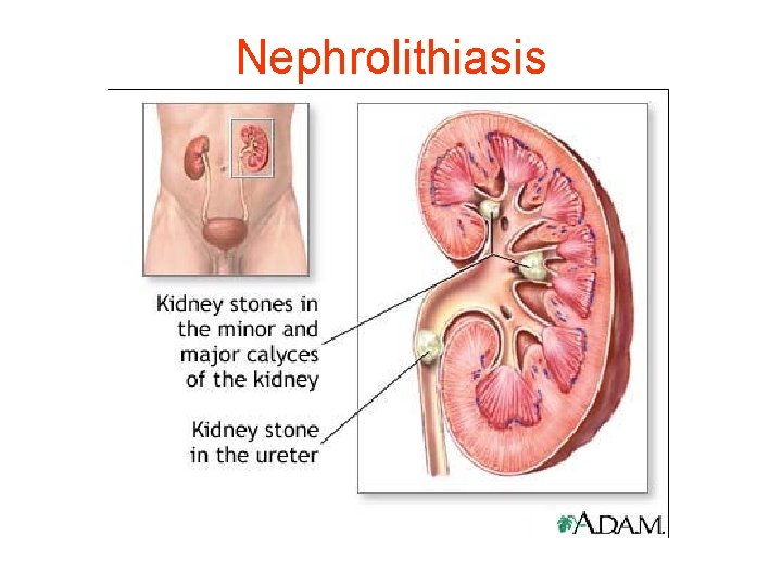 Nephrolithiasis 