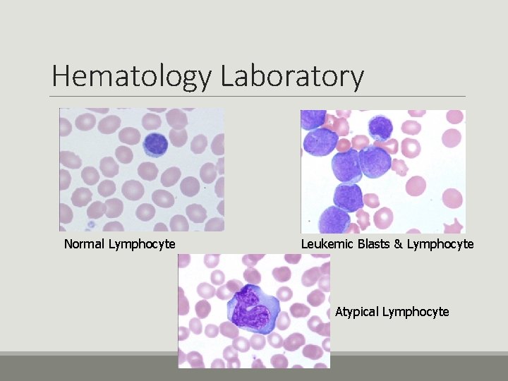 Hematology Laboratory Normal Lymphocyte Leukemic Blasts & Lymphocyte Atypical Lymphocyte 