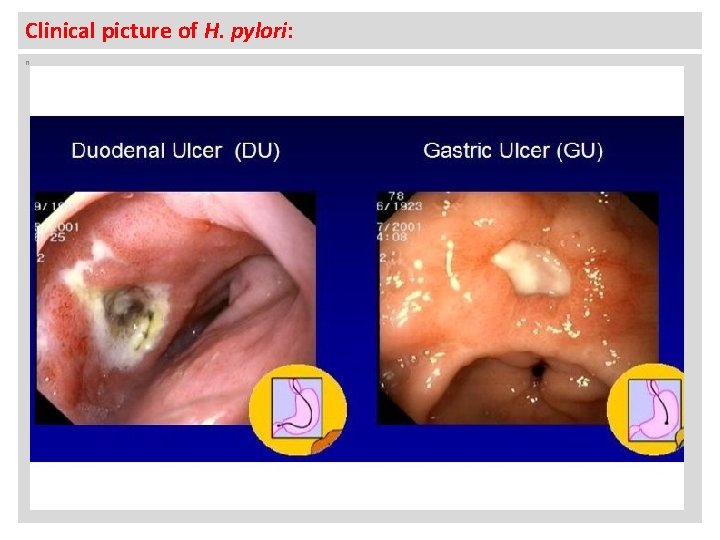 Clinical picture of H. pylori: n 