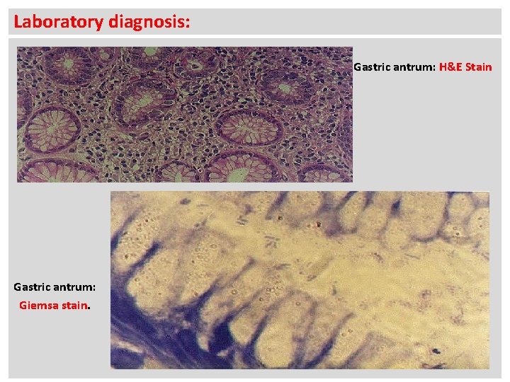 Laboratory diagnosis: Gastric antrum: H&E Stain Gastric antrum: Giemsa stain. 