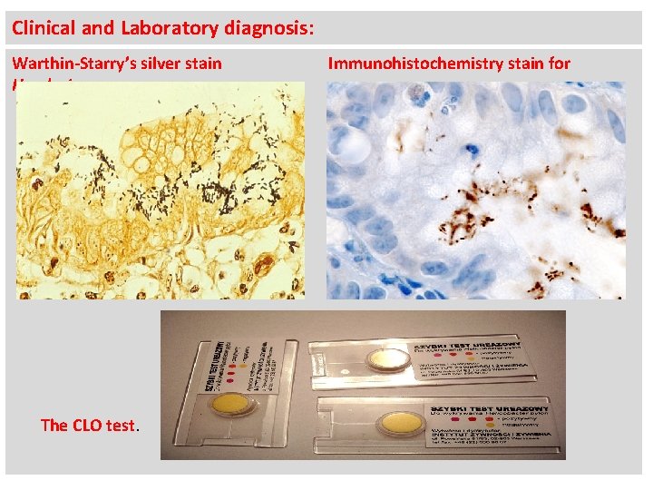 Clinical and Laboratory diagnosis: Warthin-Starry’s silver stain H. pylori. The CLO test. Immunohistochemistry stain