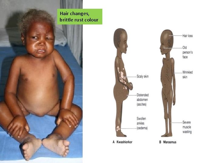 Hair changes, brittle rust colour 