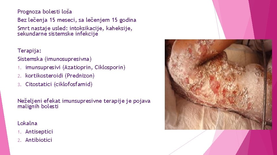 Prognoza bolesti loša Bez lečenja 15 meseci, sa lečenjem 15 godina Smrt nastaje usled: