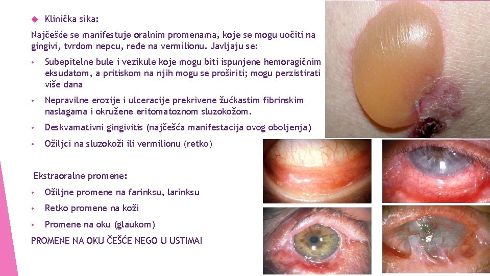  Klinička sika: Najčešće se manifestuje oralnim promenama, koje se mogu uočiti na gingivi,