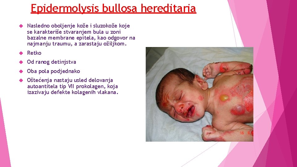 Epidermolysis bullosa hereditaria Nasledno oboljenje kože i sluzokože koje se karakteriše stvaranjem bula u