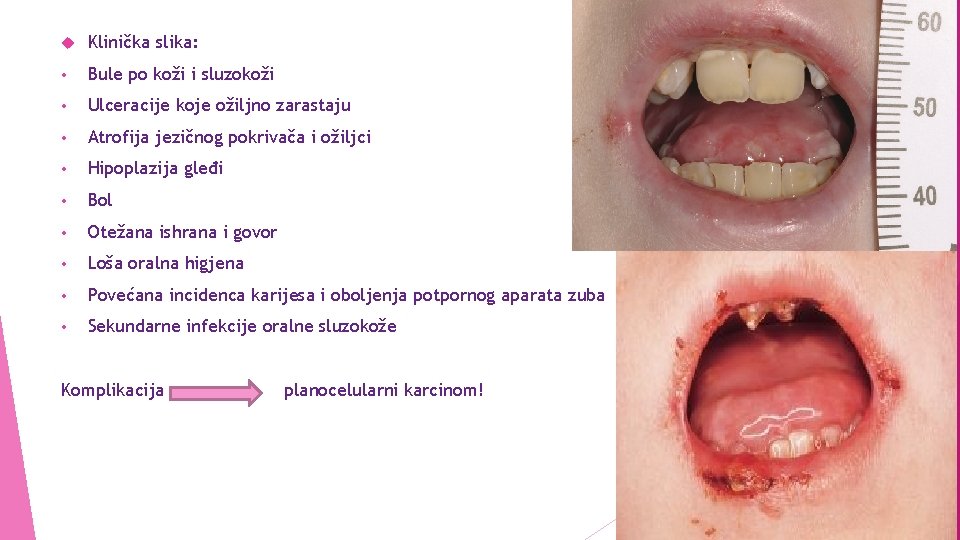  Klinička slika: • Bule po koži i sluzokoži • Ulceracije koje ožiljno zarastaju