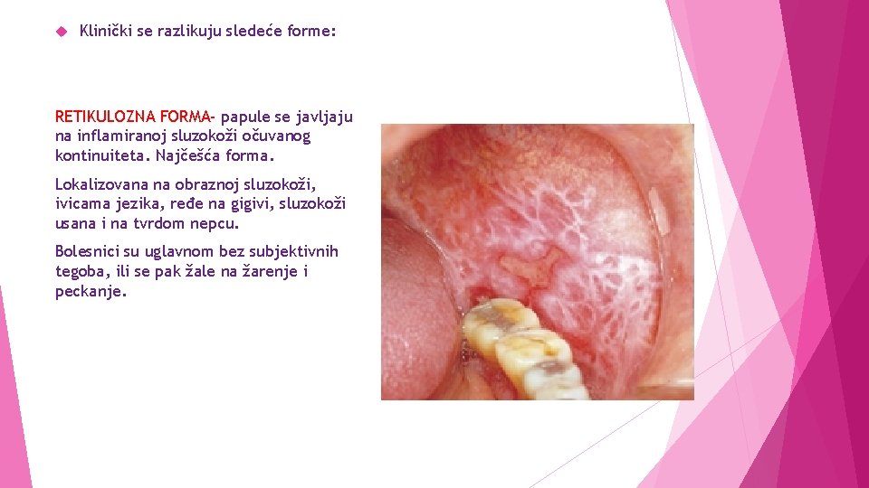  Klinički se razlikuju sledeće forme: RETIKULOZNA FORMA- papule se javljaju na inflamiranoj sluzokoži