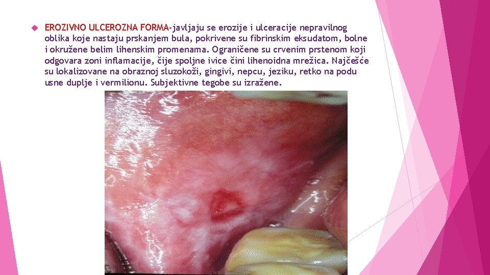  EROZIVNO ULCEROZNA FORMA-javljaju se erozije i ulceracije nepravilnog oblika koje nastaju prskanjem bula,