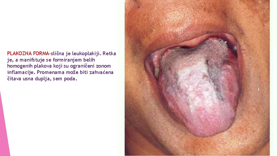 PLAKOZNA FORMA-slična je leukoplakiji. Retka je, a manifstuje se formiranjem belih homogenih plakova koji