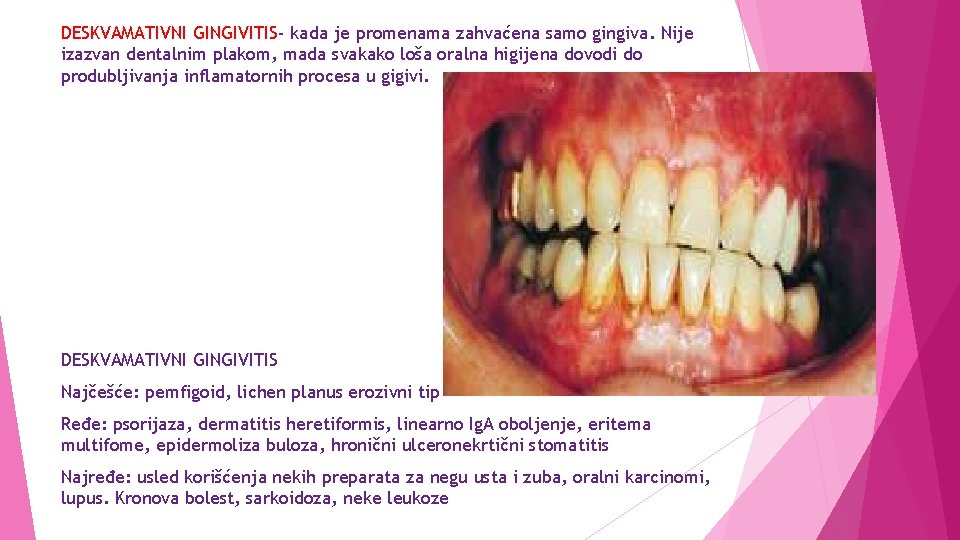 DESKVAMATIVNI GINGIVITIS- kada je promenama zahvaćena samo gingiva. Nije izazvan dentalnim plakom, mada svakako