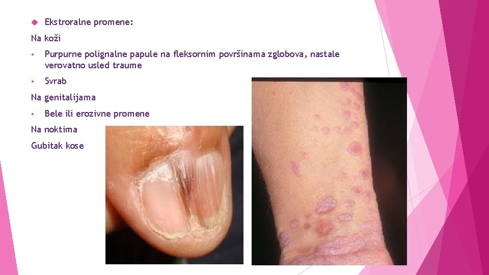  Ekstroralne promene: Na koži • Purpurne polignalne papule na fleksornim površinama zglobova, nastale