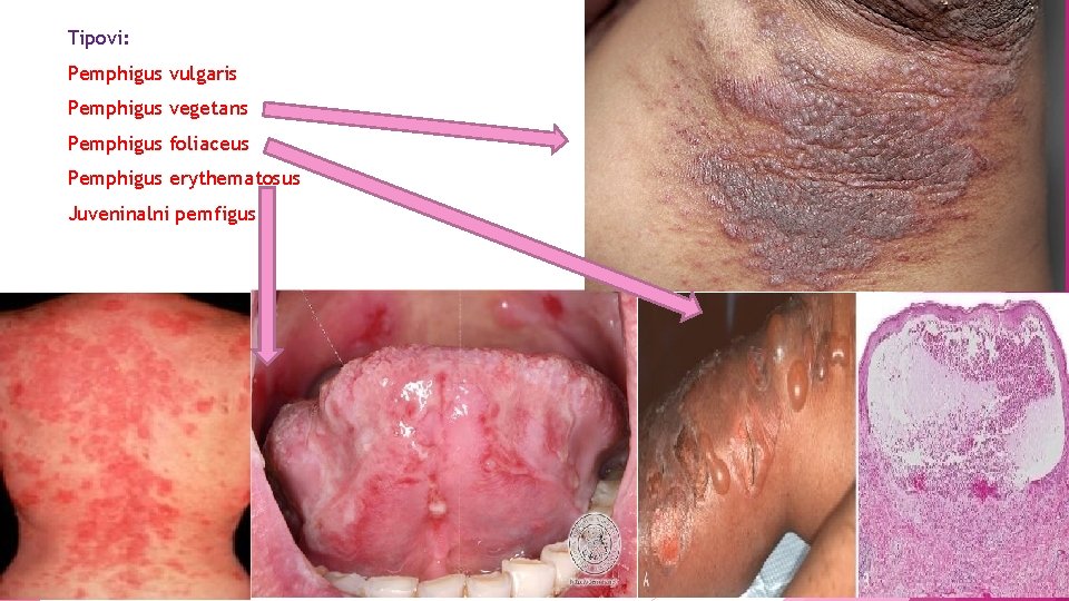 Tipovi: Pemphigus vulgaris Pemphigus vegetans Pemphigus foliaceus Pemphigus erythematosus Juveninalni pemfigus 